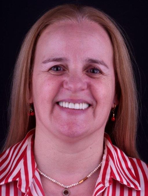 Implantes Dentários – Maria João