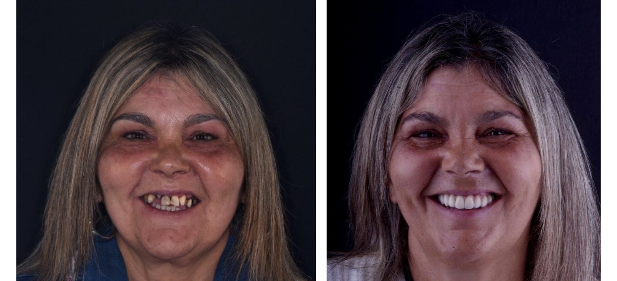 Reabilitação oral total antes depois Maria Santana